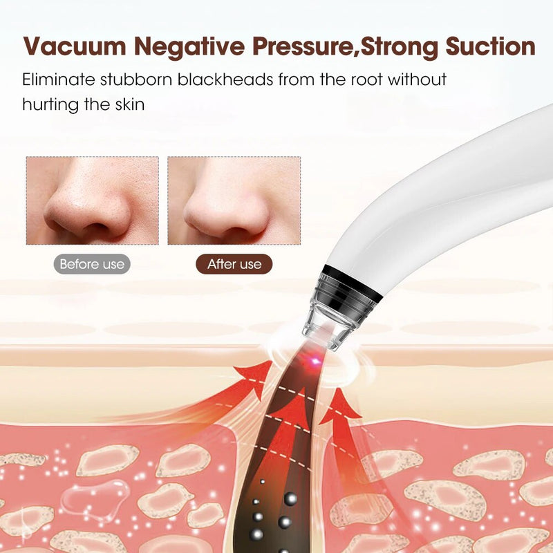 electric pore vacuum, view 6 - MRSLM